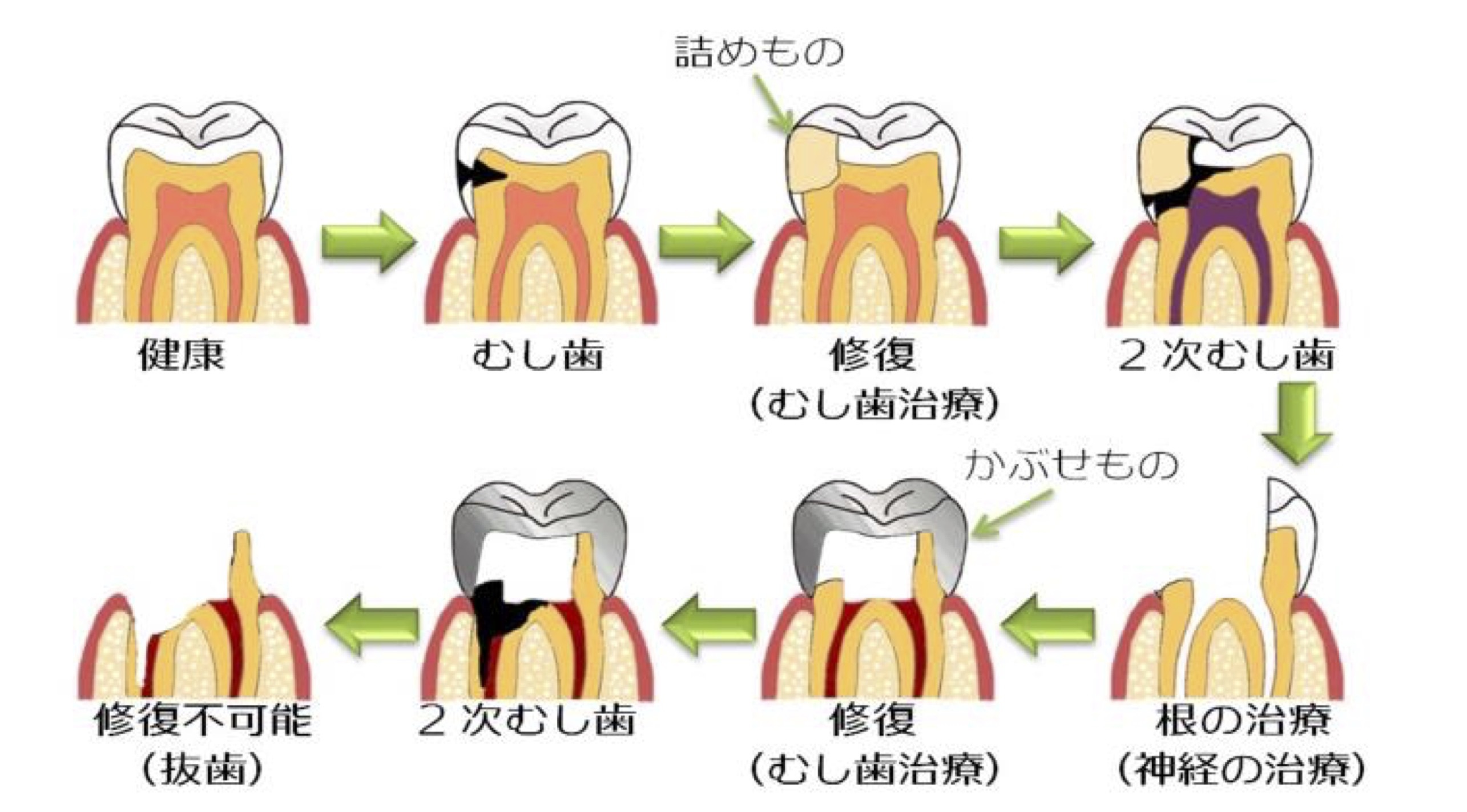 メンテナンス　カリエス