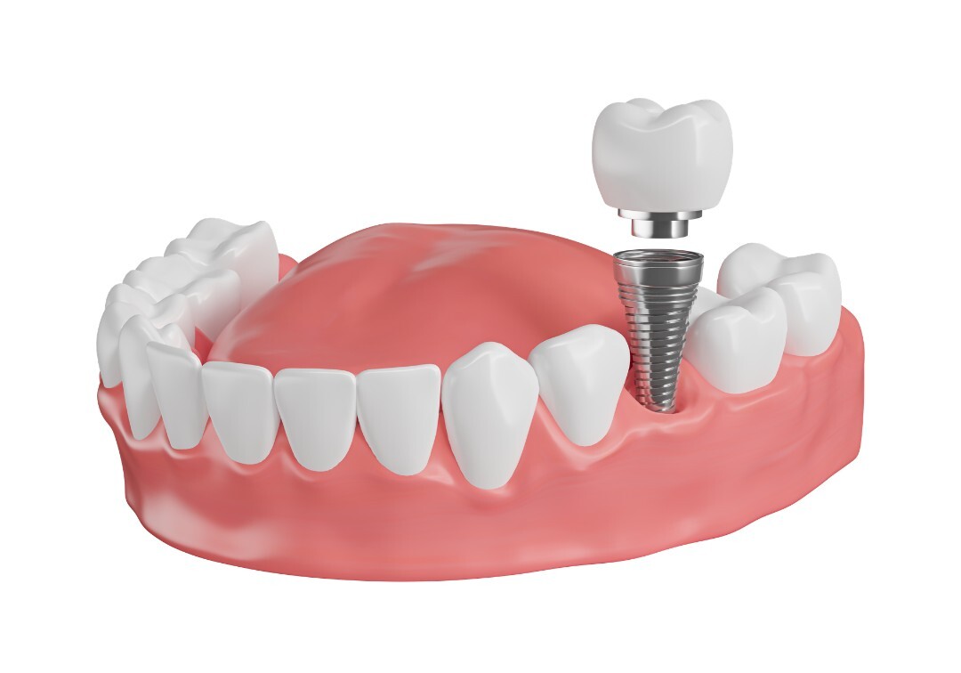 awaza-nishinagahori-implant-surgery