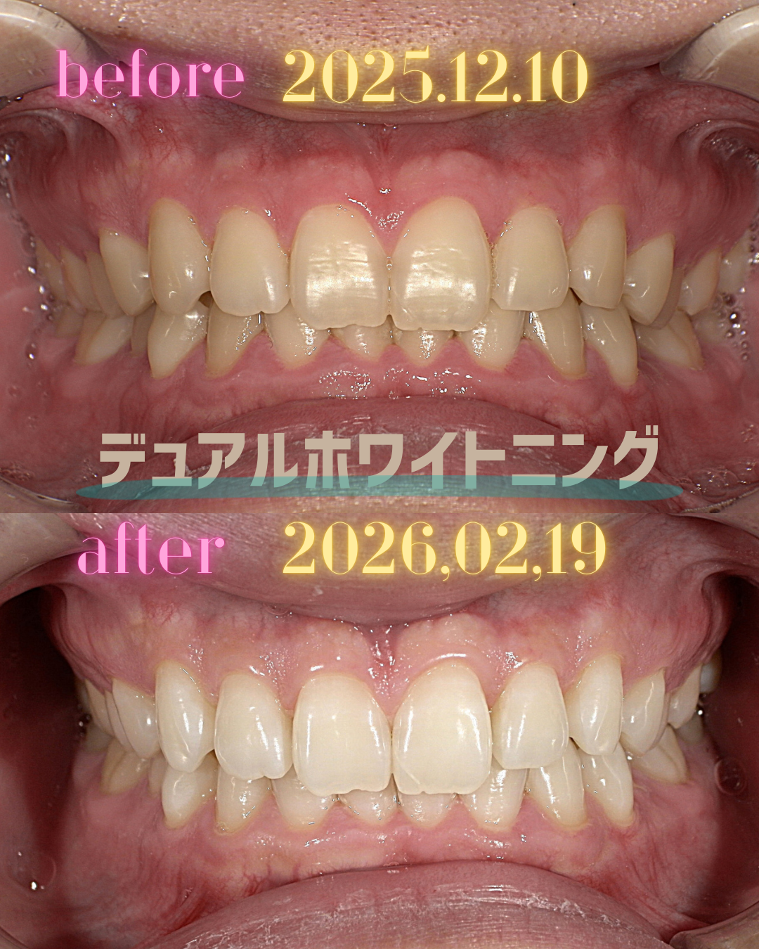 nishinagahori_whitening