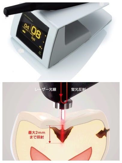 ダイアグノデントペン