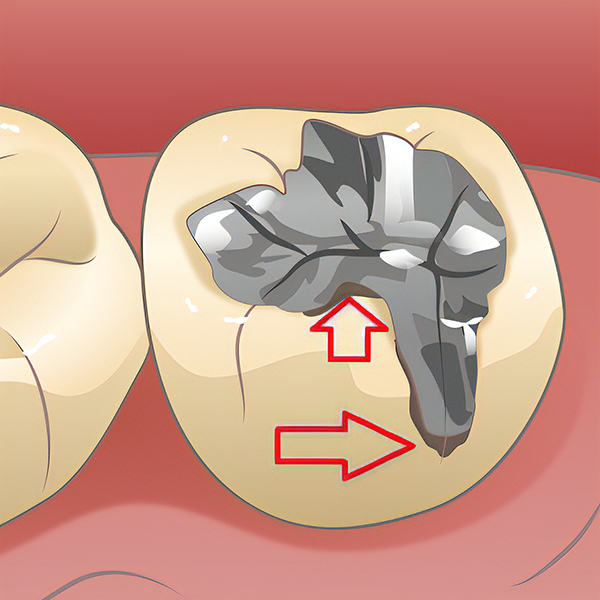 img_treatment-tooth01