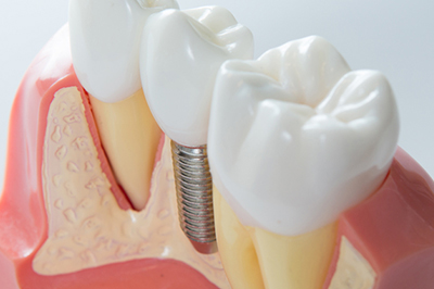 7-5インプラント