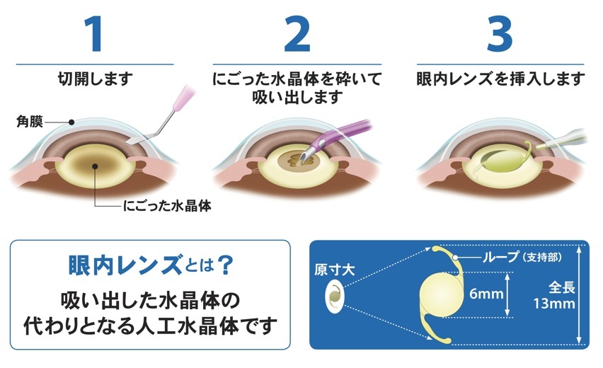 白内障手術 画像