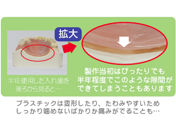 プラスチックの磨耗（5年間使用後）
