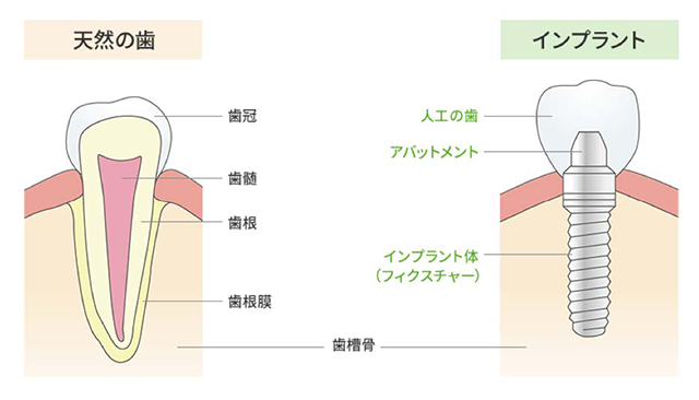 インプラント比較