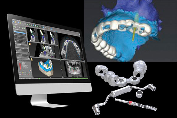 インプラント変更１
