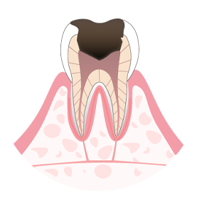 虫歯03