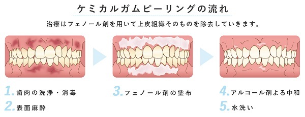 gum_peeling03img0101