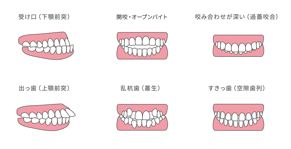 成人矯正