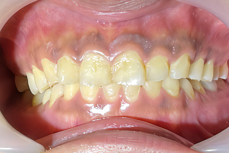 img_whitening_and_gum_peeling01