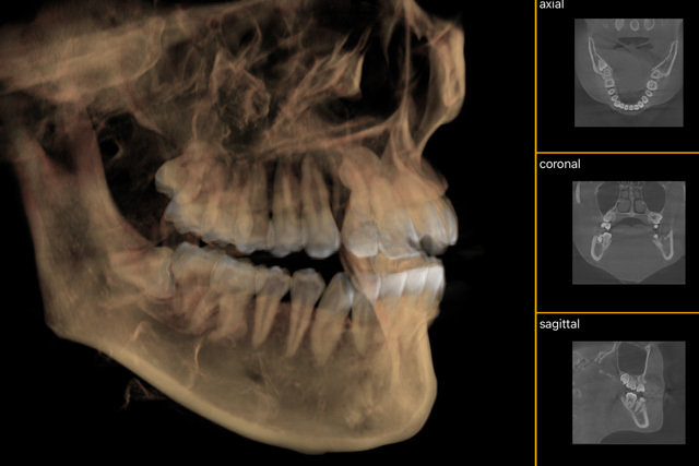 img_wisdom_tooth_extraction01