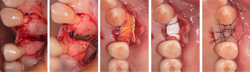 img_implant03