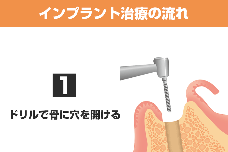 implant_flow