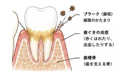歯周病